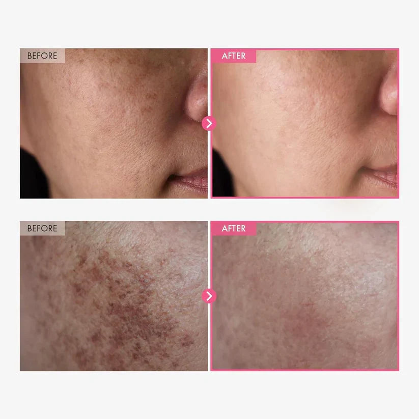 Dark Spot Corrector Cream | Korean Arbutin Brightening Cream
