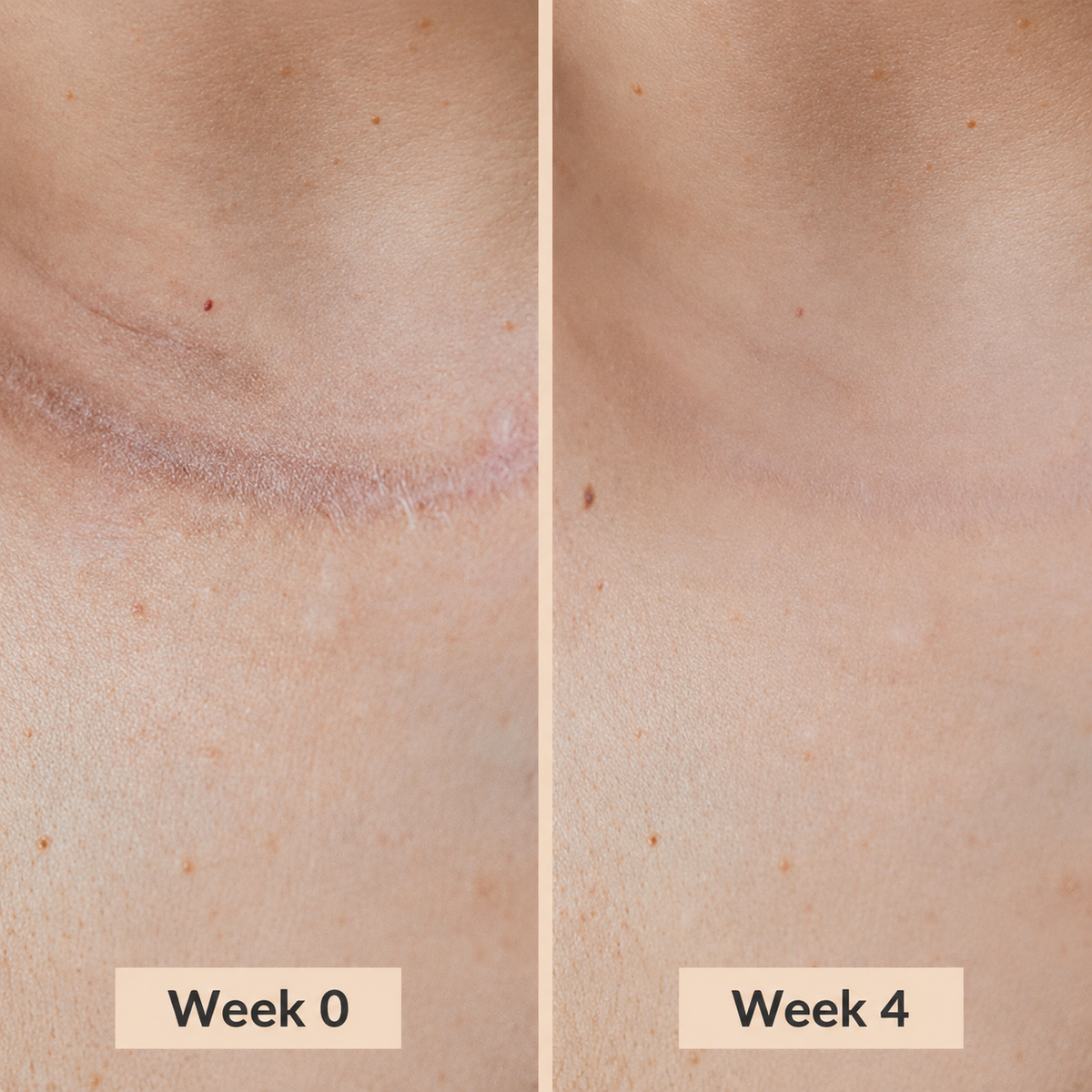 Silicone Scar Stick